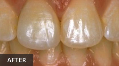 Dental whitening results showing brightened front teeth after professional treatment procedure.