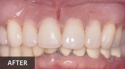 Close-up of upper front teeth after dental treatment showing bright, even, white smile results.