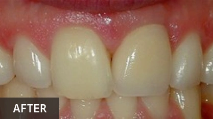After cosmetic dental treatment showing four restored front teeth with improved whiteness and alignment.