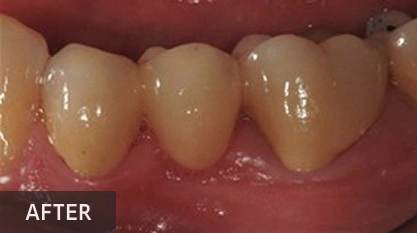 Close-up of dental restoration showing four teeth with natural-looking crowns after treatment.