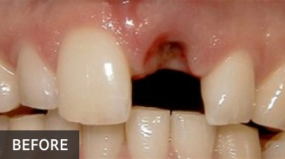 Before dental implant: missing front tooth gap between two natural teeth