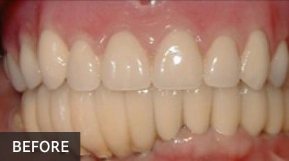 Before dental treatment showing crowded, discolored upper and lower teeth with uneven spacing.