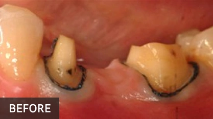 Dental before photo showing two damaged teeth with decay and discoloration on gum tissue.