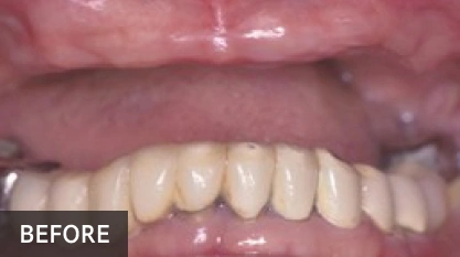 Before dental treatment showing discolored upper front teeth with gum recession