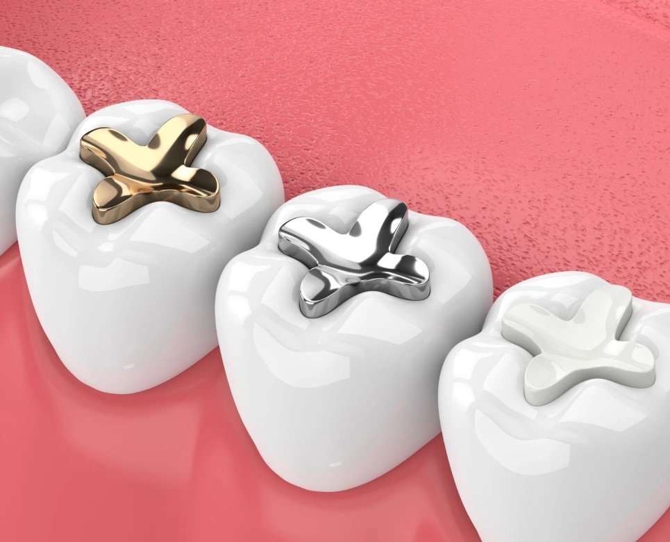 Three white tooth models on pink background displaying gold and silver dental crowns and restorations.