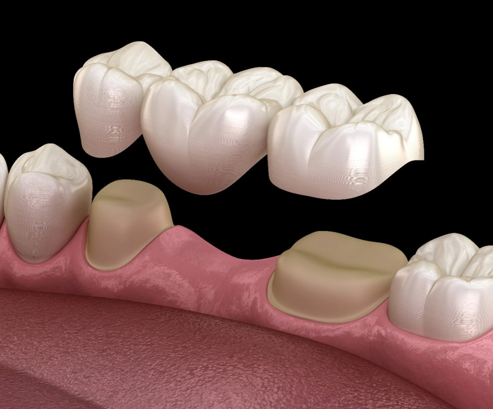 Dental crown & Bridges