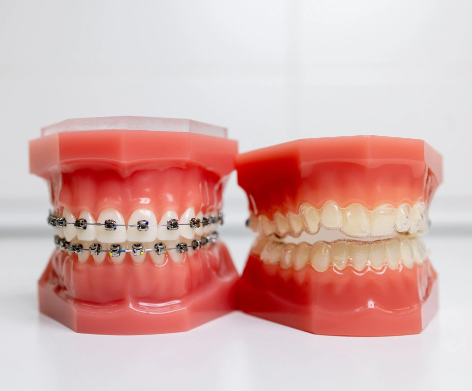 Invisalign Vs Traditional Braces